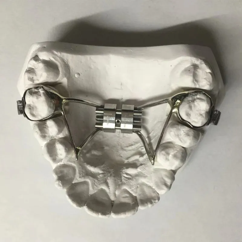 Rapid Maxillary Expansion