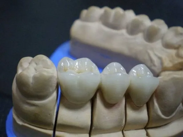 Dental Laboratoriyada Başdan Sona qədər Sabit Bərpa Diş Ənənəvi İşi Tac və Körpü