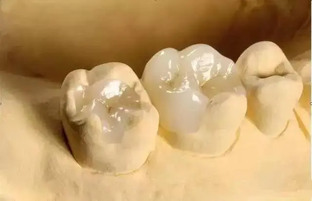 Təbiət Dişinin Kiçik Səthi Qüsurunu Xilas Etmək üçün Zirconia Dental İnley