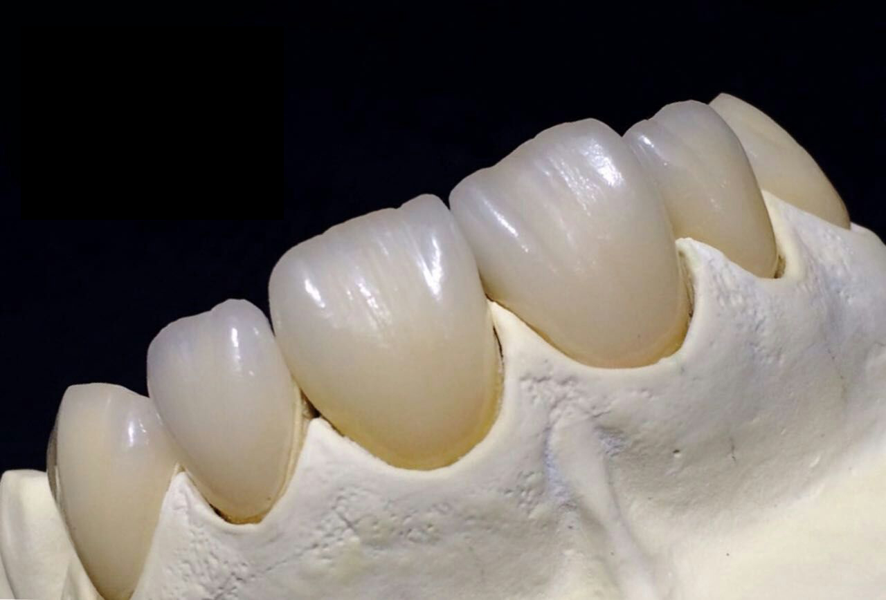 Precautions about zirconia porcelain teeth