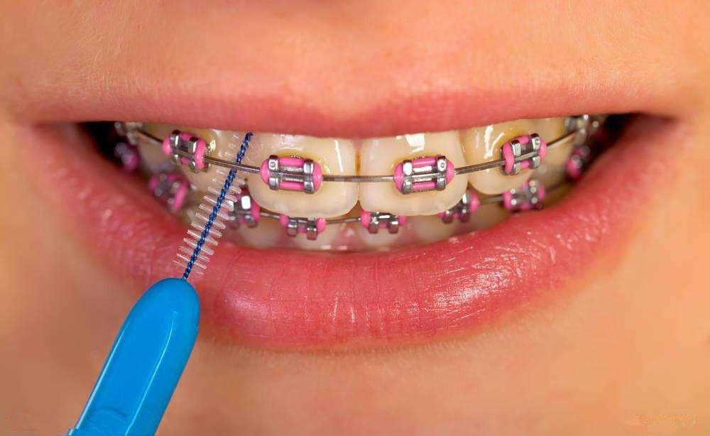 What should we do if tooth enamel is damaged during wearing the orthodontic brace? 
