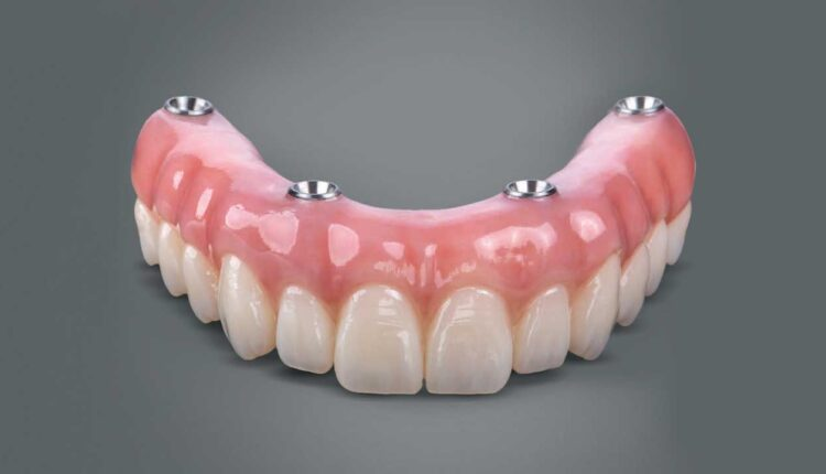 Dental implant restorations, how long does it last?