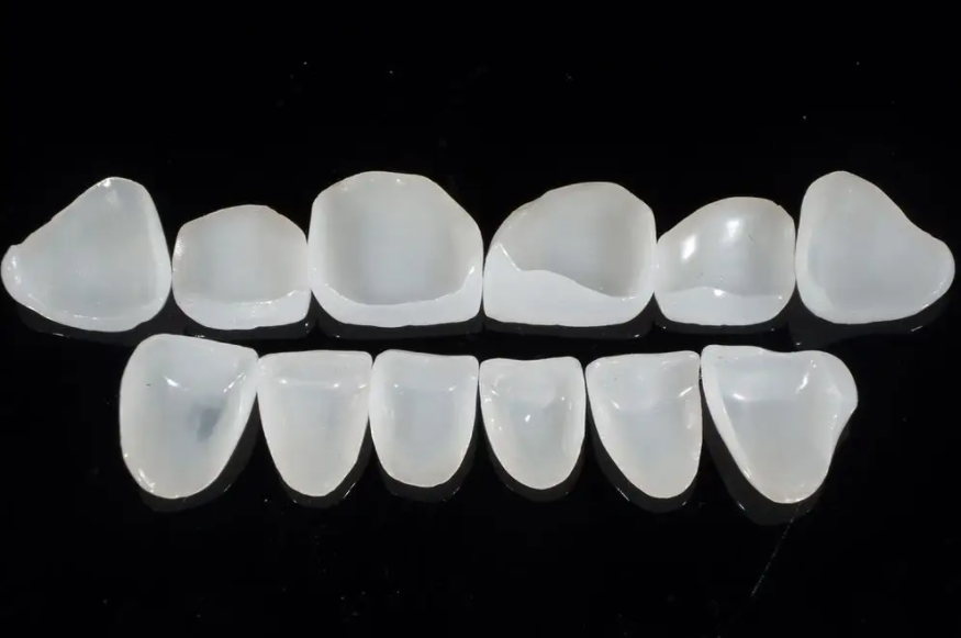  What are the advantages of dental veneers?