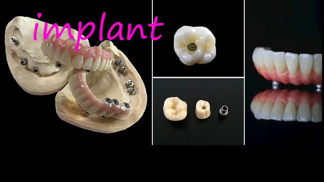 Implantes Dentales