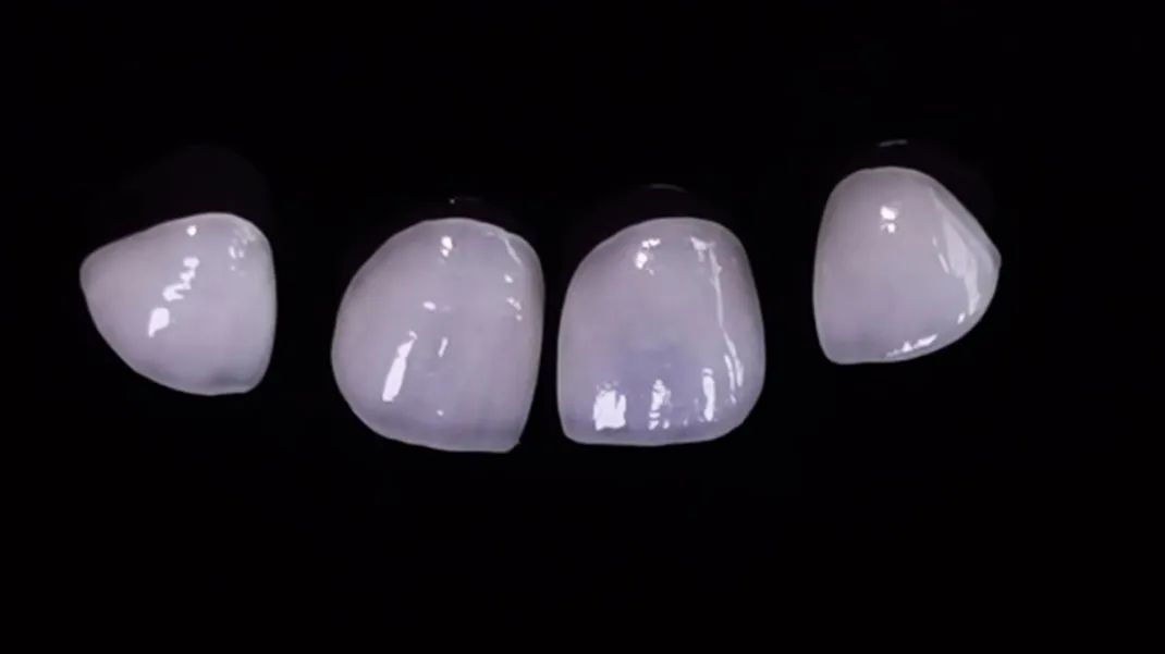 Dental Laminate Veneers