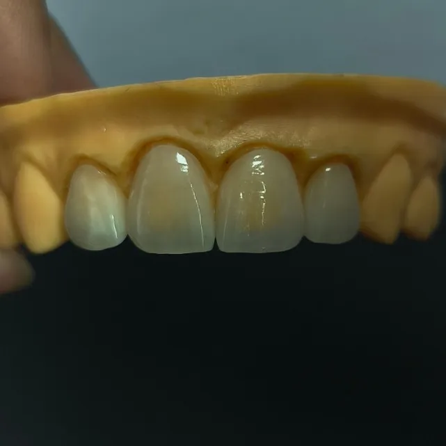 High Translucent Dental Veneers Layered Emax Veneer