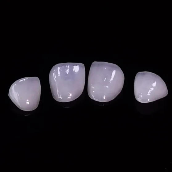 Hight Translucent Dental Veneers Layered Emax Veneer Dental lab work