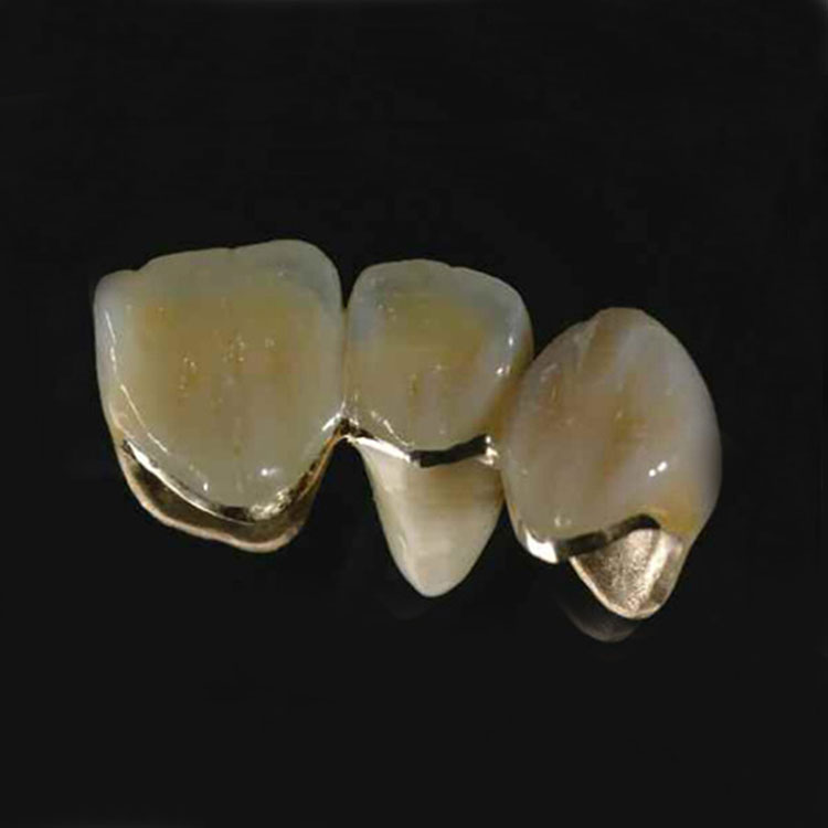 How to choose the suitable porcelain tooth material?