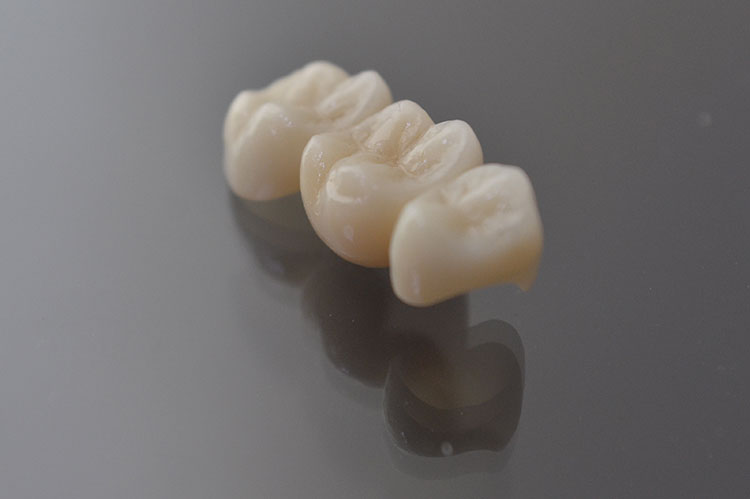 Advantages of zirconia all-ceramic teeth