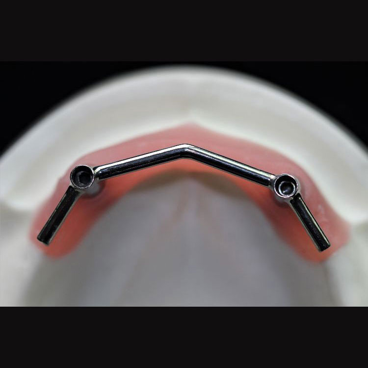 Implant Bar