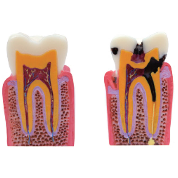 Model de dinte pentru cariile dentare