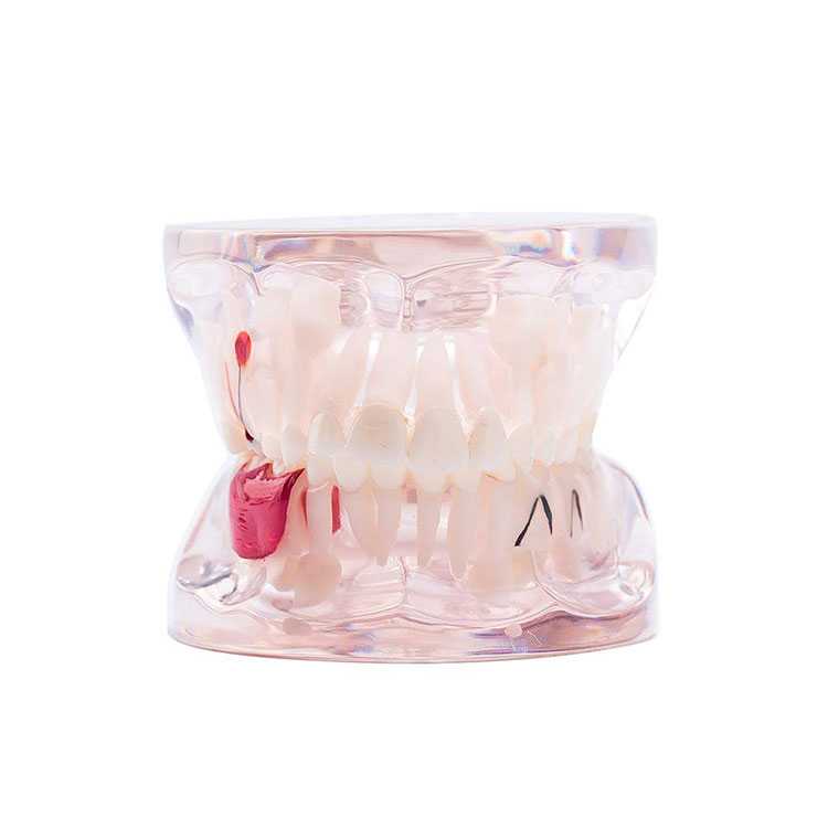 Fogászati ​​fogak patológiai vizsgálati modellje