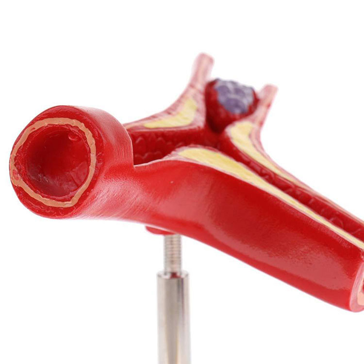 İnsan aterosklerozunun ürək-damar modeli