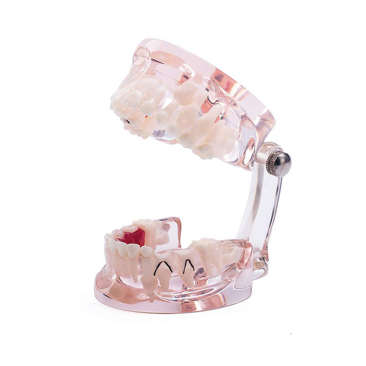 दंत दात पॅथॉलॉजी अभ्यास मॉडेल