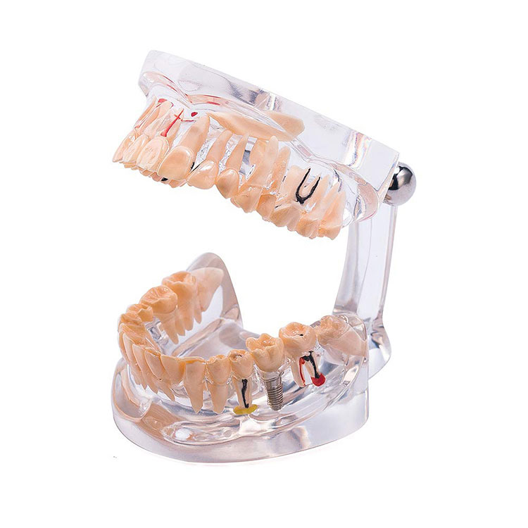 病理学の歯のモデル