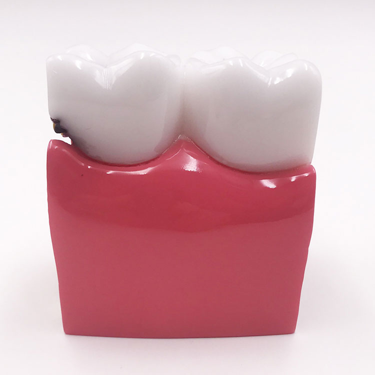 Modelo de diente de caries dental