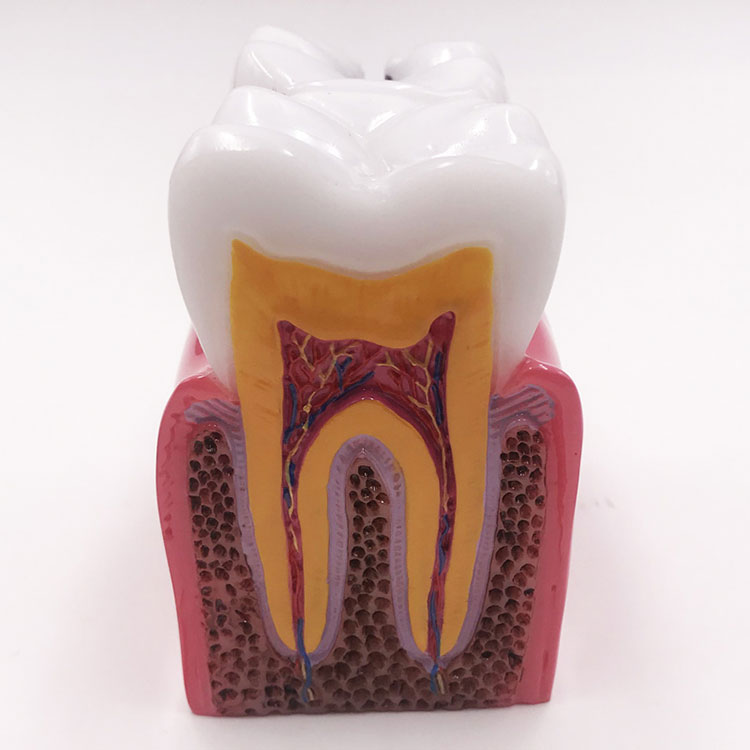 Зубна модель карієсу