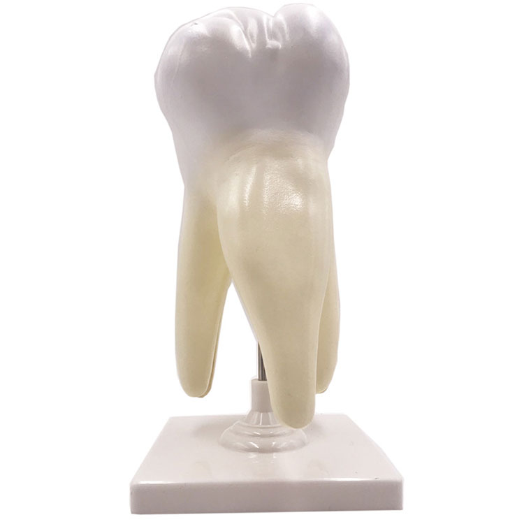 Triple Root Molar with Caries Model