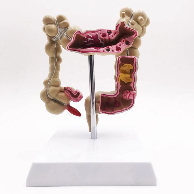 Model hrubého čreva s lekárskymi chorobami
