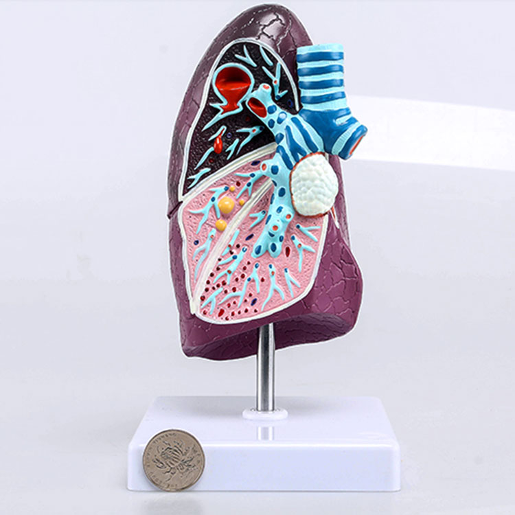 Pathological Lung Model - 3 