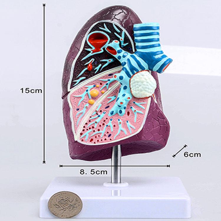 Pathological Lung Model - 1 