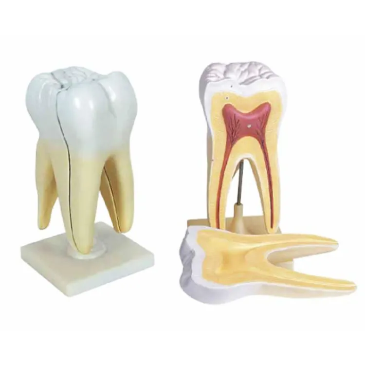 Triple Root Molar With Caries Model