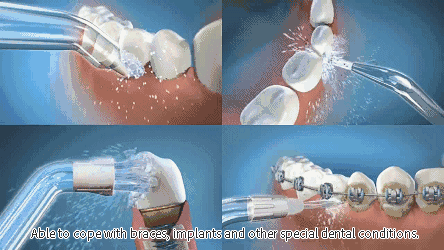 The importance of using a Water Flosser Oral Irrigator - News - Wopin