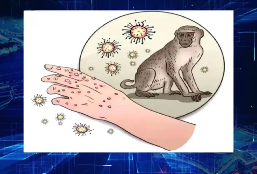 Monkeypox வைரஸ் பற்றி நீங்கள் தெரிந்து கொள்ள வேண்டியது என்ன?