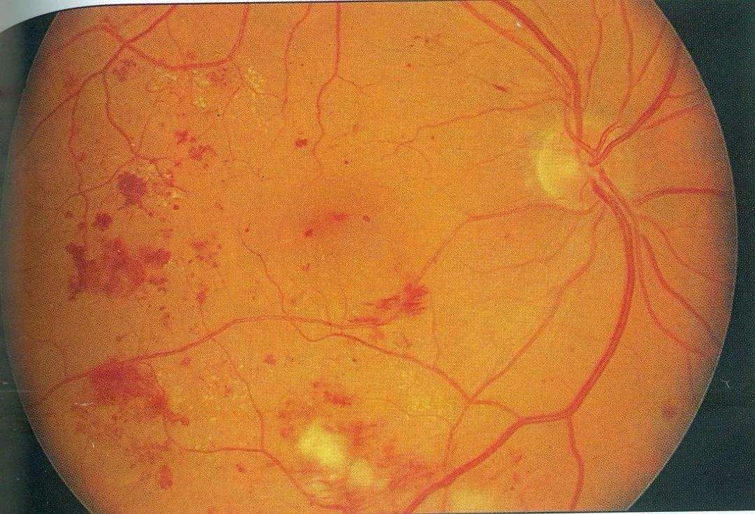 Aminoguanidine and diabetic retinopathy