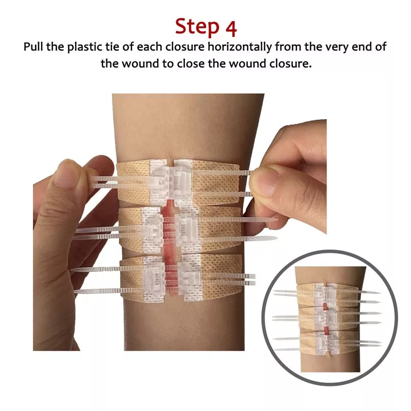 Medical surgical Sterile Adhesive Emergency Wound Closures strips