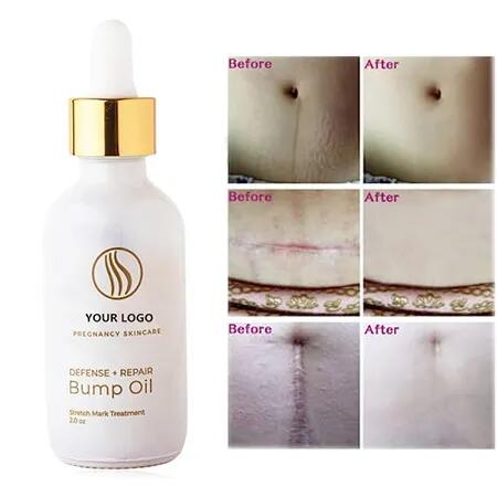 Repair And Healing Stretch Marks Remover Essential Oil
