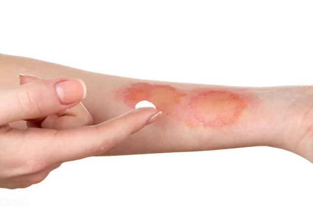 How to deal with burns?