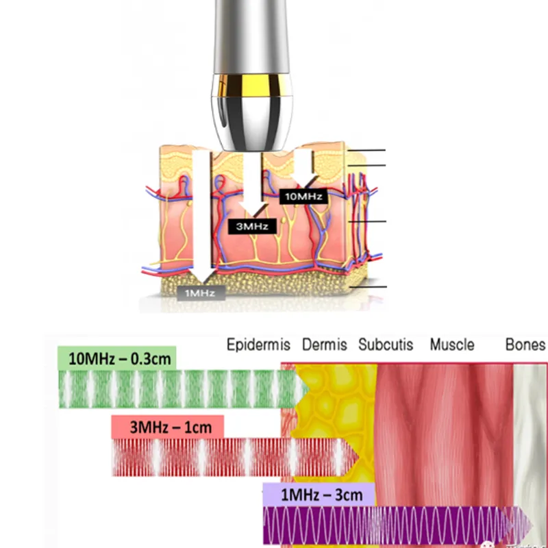 The10MHz Ultrasonic Beauty Instrument desenvolvido pela empresa