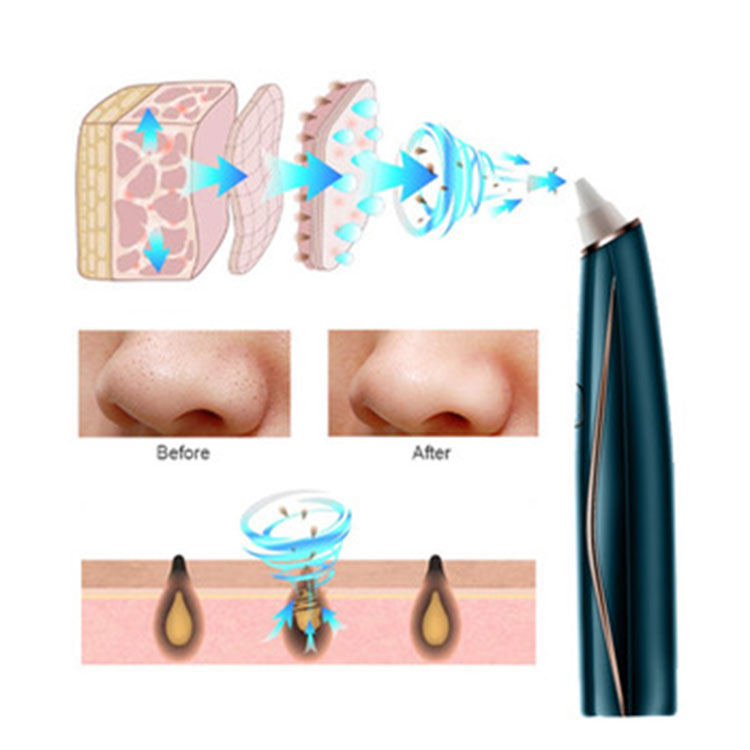 Pore Acne Cleansing Electric Blackhead Remover