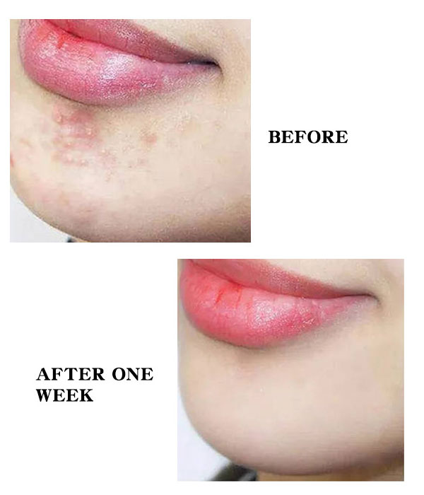 Invisible Concealer Acne Clearing Patch